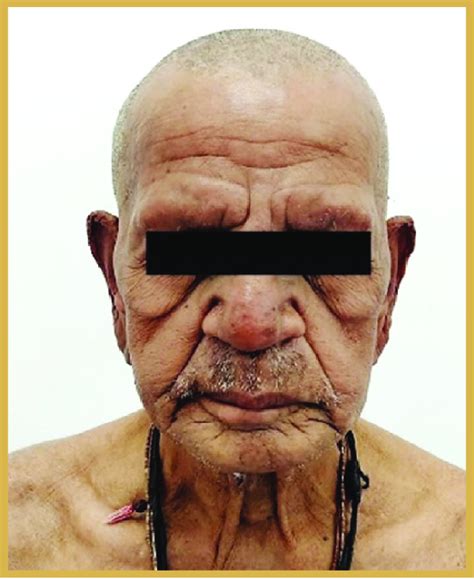 A Leonine Face Of Lepromatous Leprosy Download Scientific Diagram