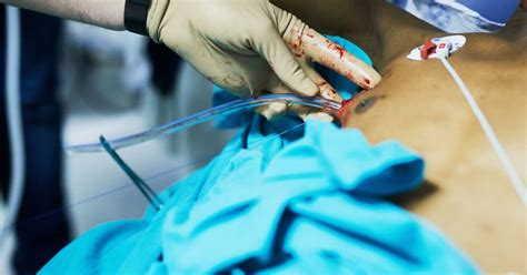 Chest Tube Insertion Uses Procedure And Recovery