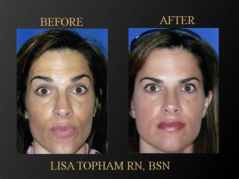 Dysport Injections Fairfield County Facial Fillers And Cheek Fillers