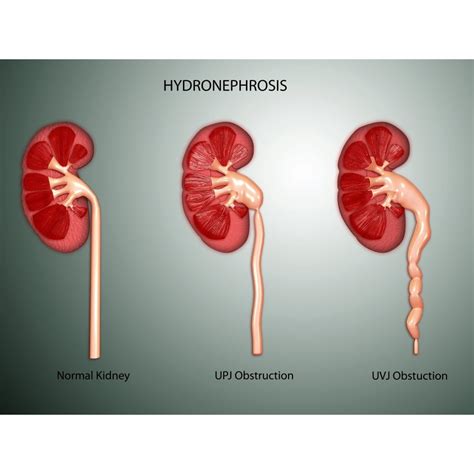 Hydronephrosis Is A Condition That Typically Occurs When One Kidney