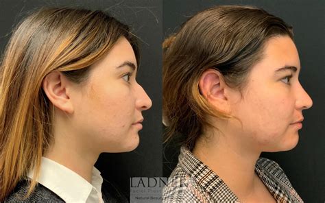 Rhinoplasty Nose Job Before And After Pictures Case 116 Denver Co