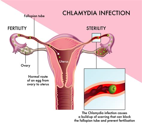 Can Chlamydia Cause Infertility Cherokee Women S Health