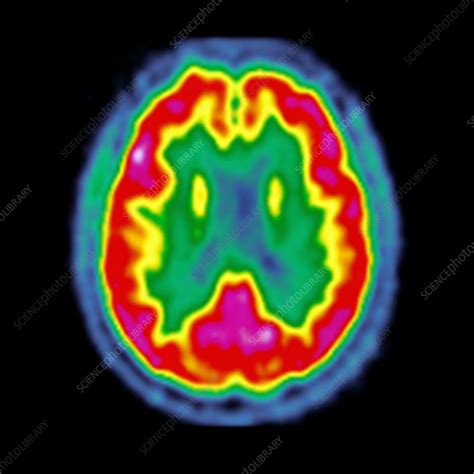 Normal Brain Activity Pet Scan Stock Image C0267612 Science Photo