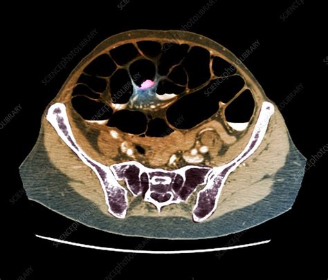 Colon Cancer Ct Scan Stock Image C0479253 Science Photo Library