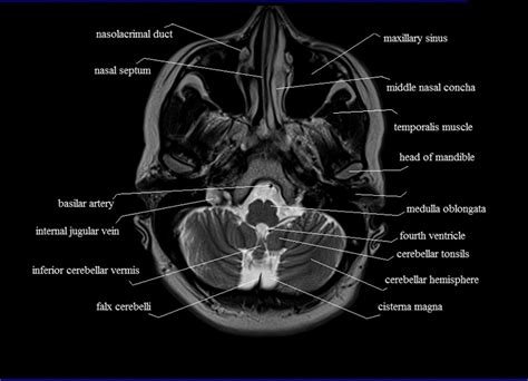 Mri Anatomy Free Mri Axial Brain Anatomy