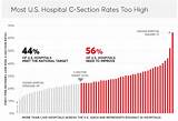 Pictures of C Section Rates By Doctor