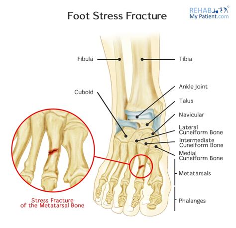 Exercise With Stress Fracture In Foot Online Degrees