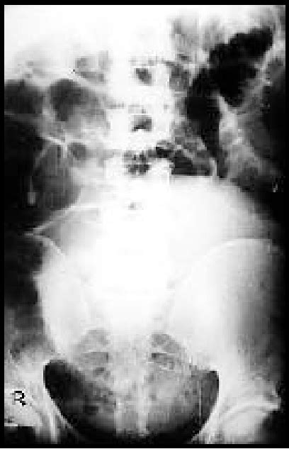 Figure 1 From Spontaneous Intraperitoneal Expulsion Of An Unruptured