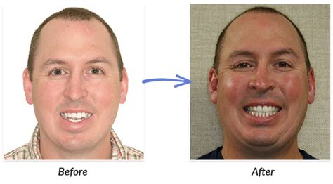 How Braces Change Face Shape Before And After