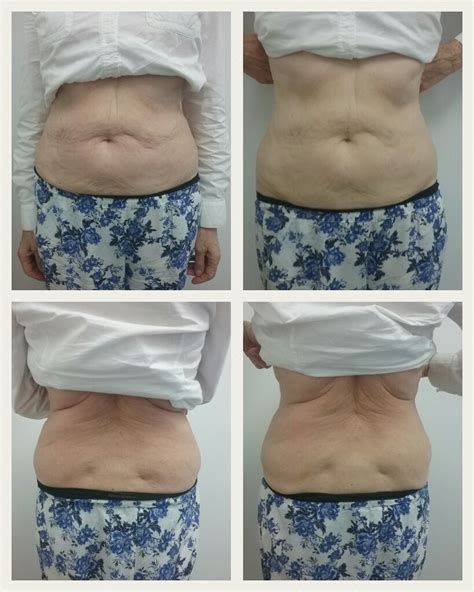 Cavitation Before And After Dermal Solutions Australia Clinic