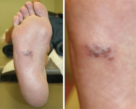 A 55 Year Old Man With A Painful Rash On The Sole Of His Foot Pain