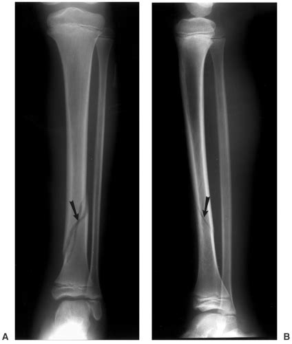 The lower leg comprises of 2 long bones, known as the fibula and the tibia, which are situated beside each other (figure 1). Tibial and Fibular Shafts | Radiology Key