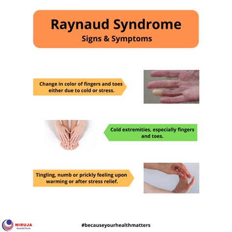 Raynaud Syndrome Cold Extremities Arteries Syndrome
