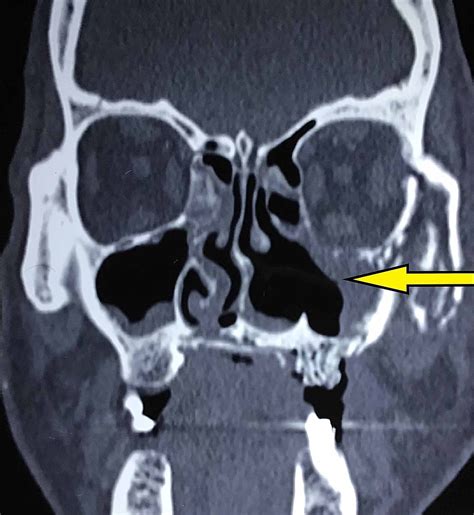 Treatment of staphylococcal infections with penicillin by intermittent sterilisation. Cureus | Mucormycosis Following Tooth Extraction in a ...