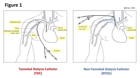 Should Tunneled Dialysis Catheters Be Placed At The Bedside In