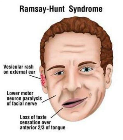 Ramsay Hunt Syndrome Facial Nerve Pediatric Specialties Oral