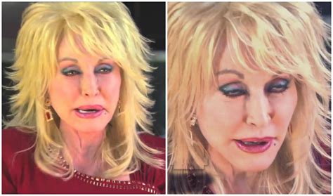 is u s singer actress dolly parton paralyzed in the face