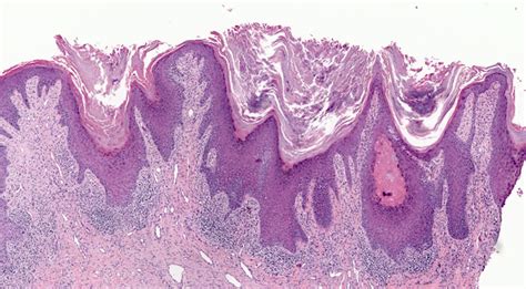 Oral Lichen Planus Histology