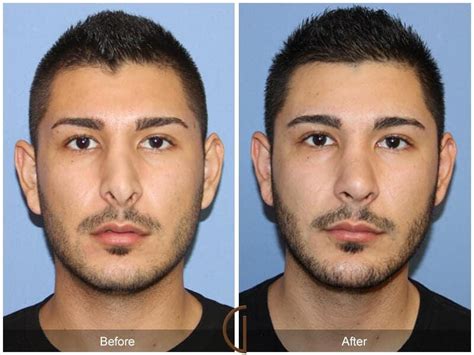 Male Rhinoplasty Before And After Photos From Dr Kevin Sadati