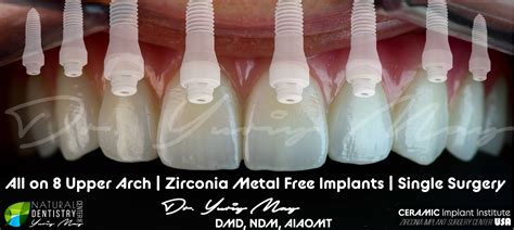 Ceramic Implants For Full Mouth Zirconia Dental Implants