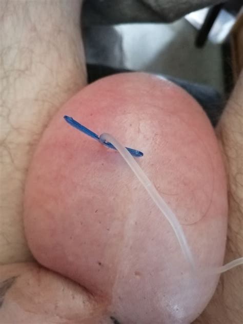 Saline Infusion Scrotum More As 2 L 48 Pics XHamster
