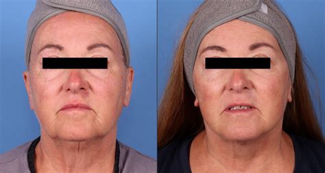 Patient 141726677 Neck Lift Before And After Photos Dr Guy Cappuccino