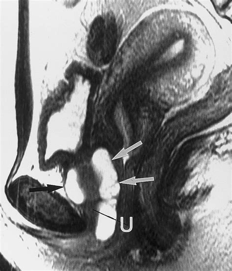 Mr Imaging Of The Male And Female Urethra Radiographics