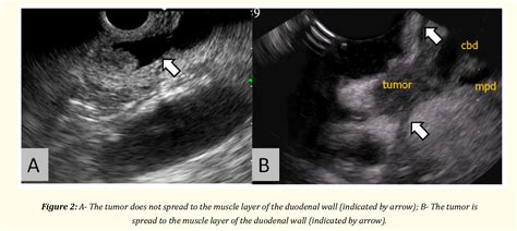 Figure From The Role Of Endoscopic Ultrasound Eus In The