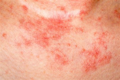 Eczema Causes Symptoms Diagnosis And Treatment Natural Health News