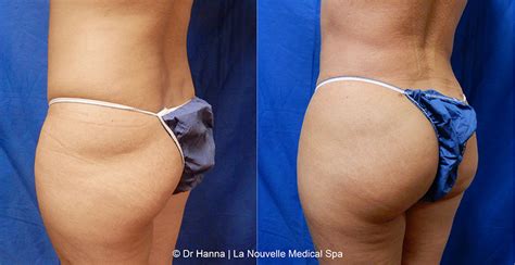 Brazilian Butt Lift Before And After Photos Ventura