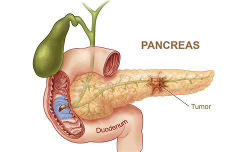 The pancreas is an organ that secretes enzymes that aid digestion by breaking down. Pancreatic Cancer - PLANETS Charity