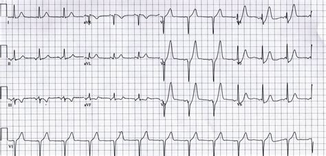 Before you read the ekg, look for: (De) Winter is coming | SinaiEM