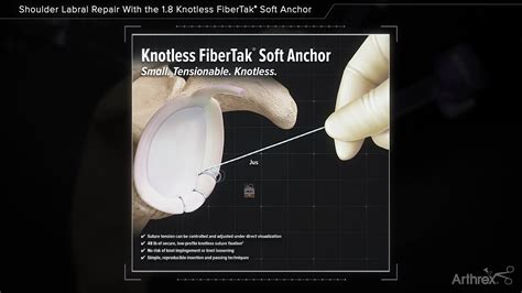 Arthrex Shoulder Labral Repair With The 18 Knotless Fibertak® Soft