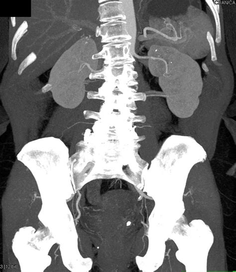 Duplicated And Obstructed Left Collecting System Due To Ureteral