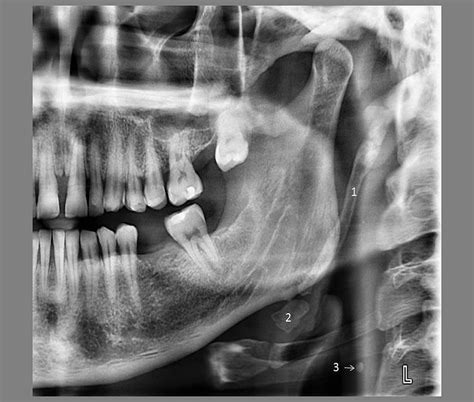 RadiologÍa Lectura De Radiografías Panorámicas Directorio Odontológico