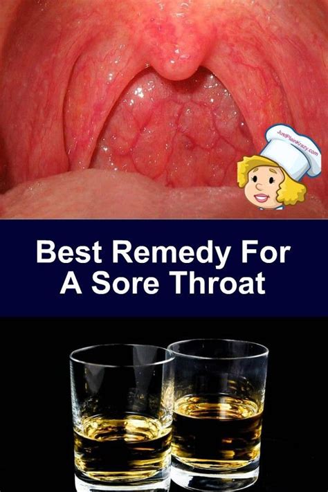 Best Remedy For A Sore Throat Throat Infection Viral Sore Throat Sore Throat