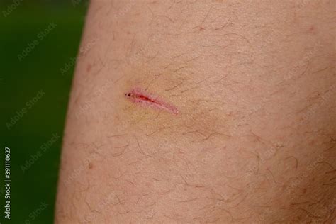 Open Wound On The Leg Caused By A Scratch Bruises And Blackness Around