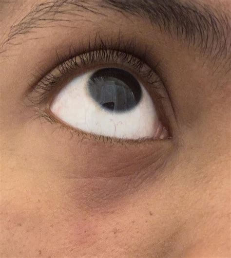 Cause Of Rash Underneath Eye Rdermatologyquestions