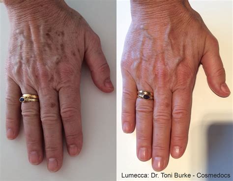Laser Skin Reduce Age Spots Freckles Rosacea Lumecca Tyler Texas