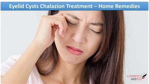 Eyelid Cysts Chalazion Treatment Home Remedies﻿ Cosmetics And You