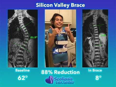 The Only Nonsurgical Scoliosis Treatment Proven To Work YouTube