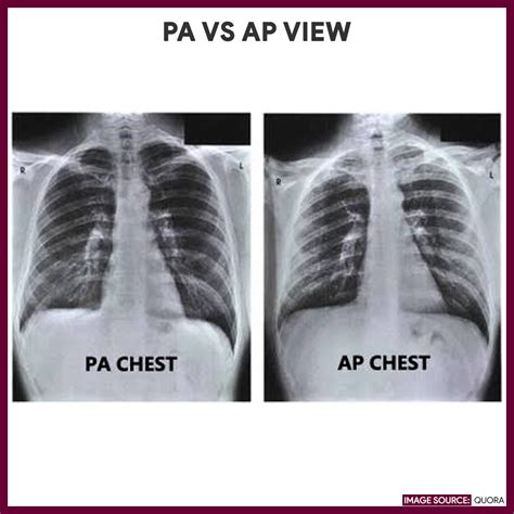 Chest X Ray Chest Radiography Nursing Responsibilities Nurseslabs