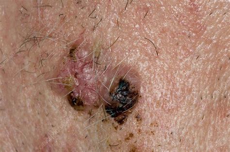 Basal Cell Skin Cancer Face