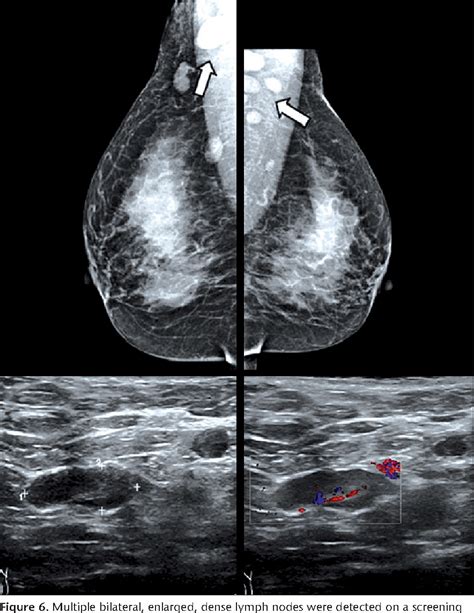 Figure 6 From Abnormal Axillary Lymph Nodes On Negative Mammograms