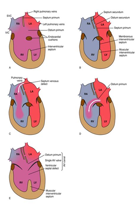 Atrial Septal Defect Pediatric Diseases And Conditions 5minuteconsult