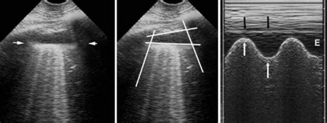 Pulmonar Ultrassonografia Point Of Care Na Gradua O