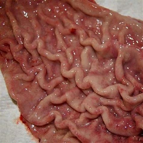 Gastric Mucosa Hot Sex Picture