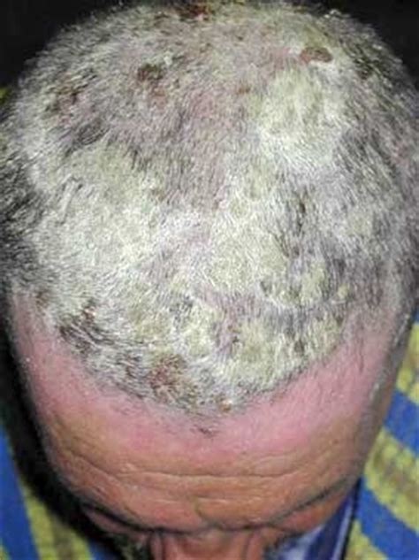 Is Scratching Your Scalp Bad Reddit - Is It Bad To Scratch Your Scalp When You Shampoo