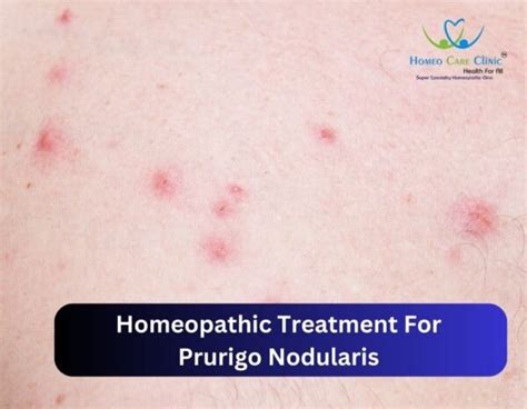 Homeopathic Treatment For Prurigo Nodularis Dr Vaseem Choudhary
