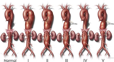 Thoracic Endovascular Aortic Repair For Aneurysm How I Teach It The